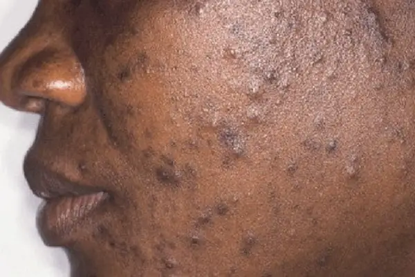 10 Best Creams For Pimples and Dark Spots in Nigeria