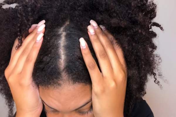 Dandruff: What it is, Causes, How to Treat it and more