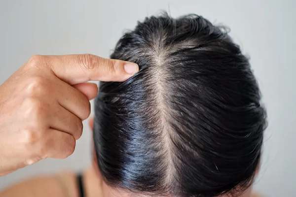 Effective Home Remedy for Oily Hair